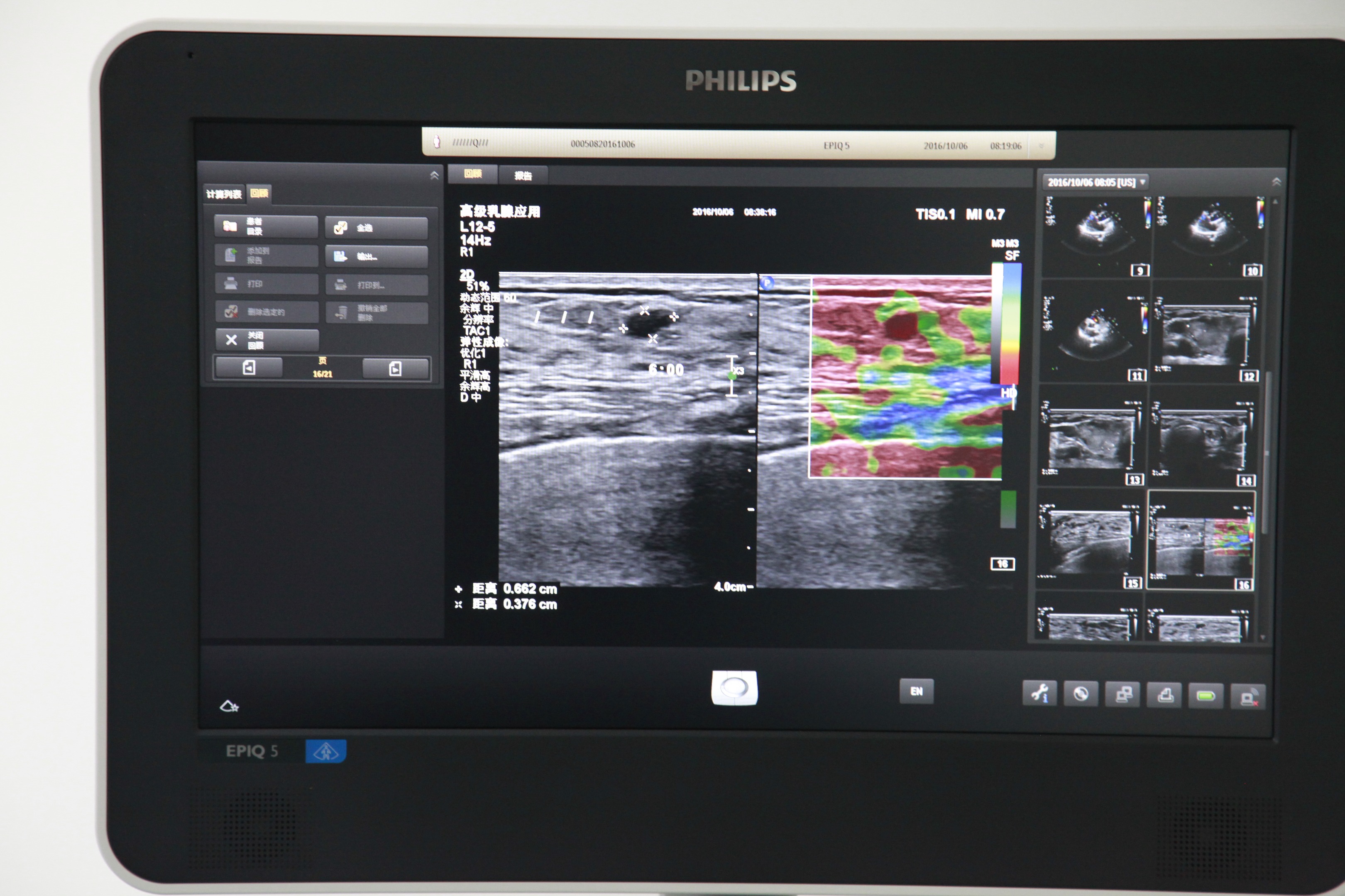 盖州市中心医院最新引进飞利浦EPIQ5高端智能超声诊断系统