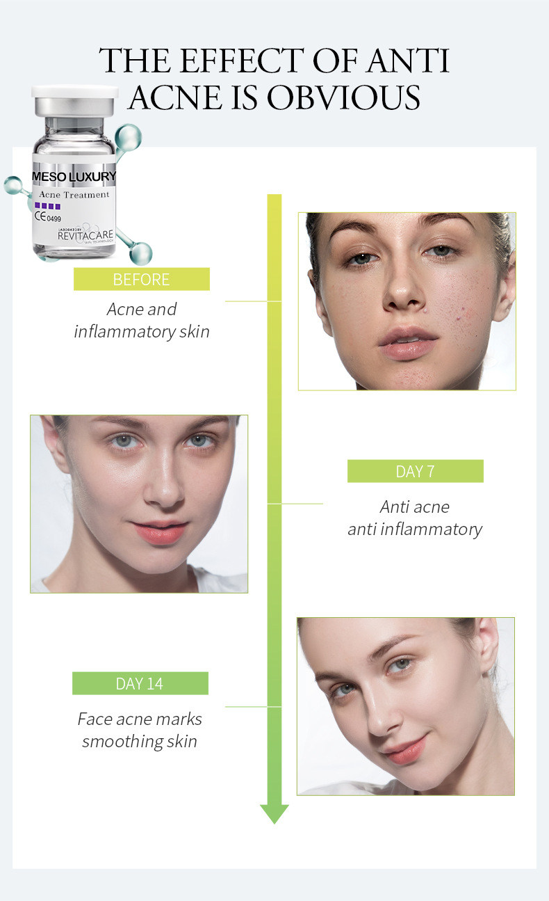 Luxury Derma Mesotheraphy-Acne Treatment