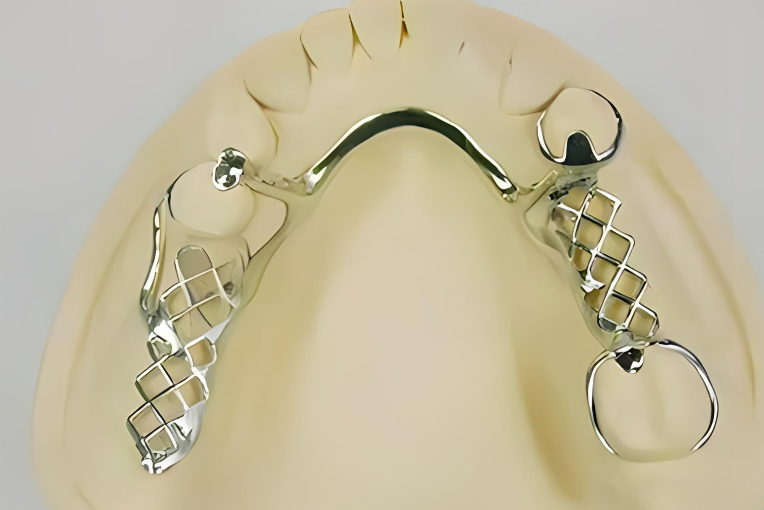 钛合金支架活动义齿