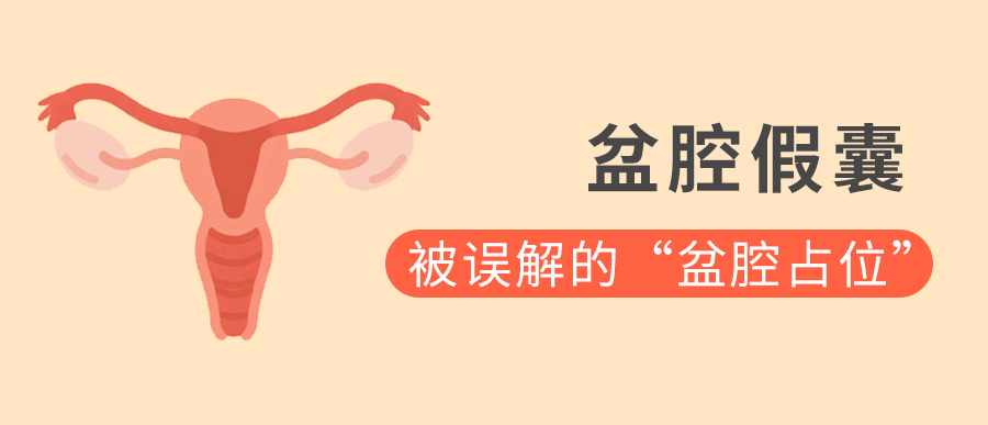 盆腔假囊：被误解的“盆腔占位”，一文读懂成因、诊断与应对