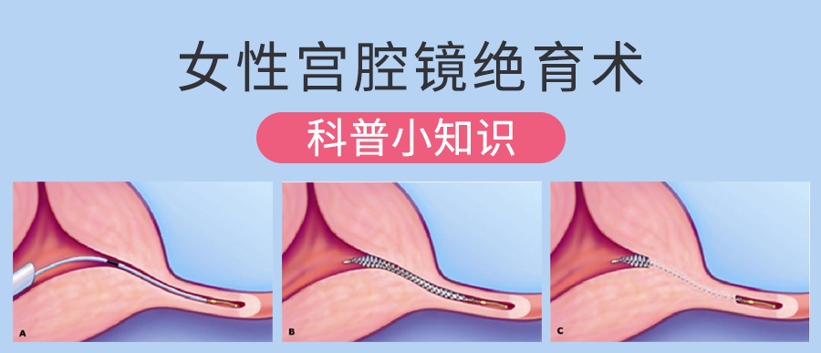 关于女性宫腔镜绝育术的科普小知识