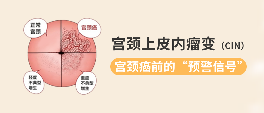 宫颈上皮内瘤变（CIN）：宫颈癌前的“预警信号”，你需要知道这些