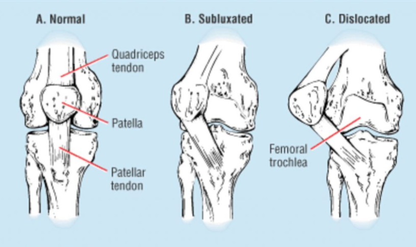 Patellar Dislocation Rehabilitation Techniques: Restoring Stability and Function