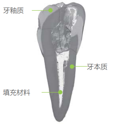 牙齿根管2