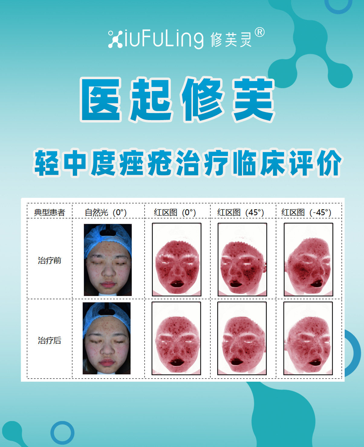 一、轻中度痤疮治疗临床评价