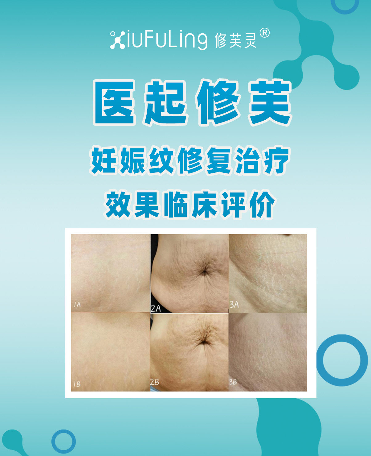 三、妊娠纹修复治疗效果临床评价