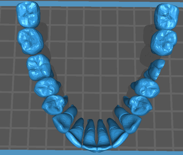 上颌牙粒（14颗）