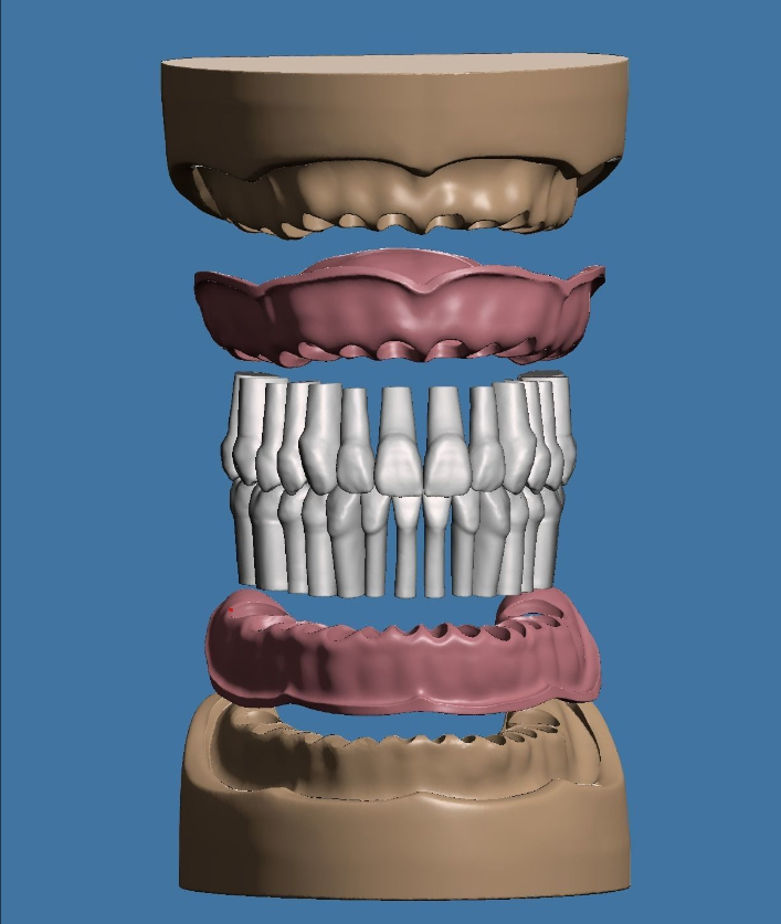 上颌和下颌牙科模型 3D 打印模型