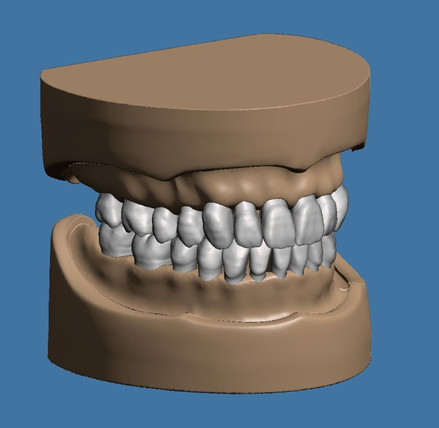 上颌和下颌牙科模型 3D 打印模型