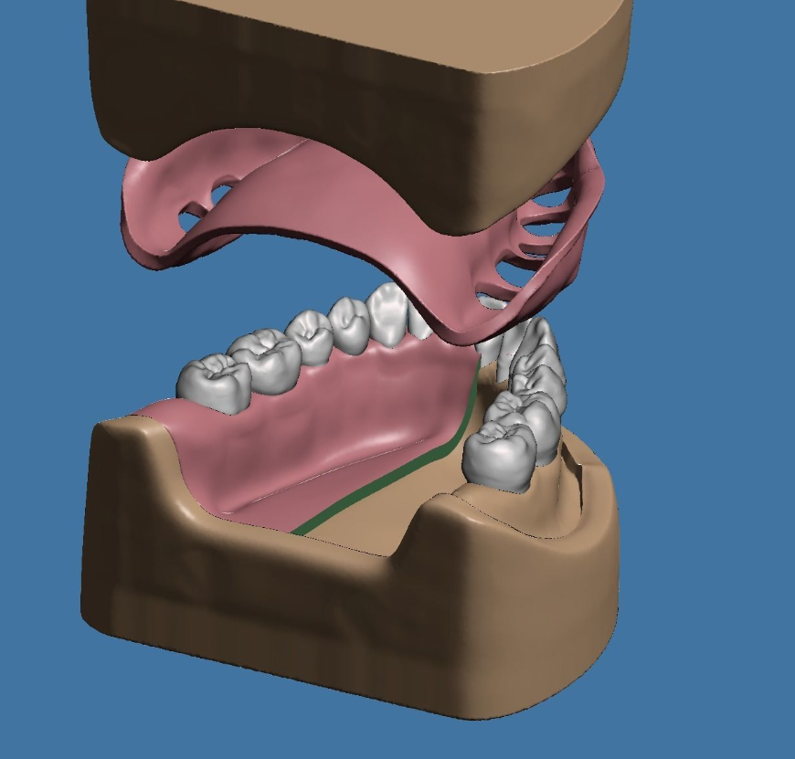上颌和下颌牙科模型 3D 打印模型