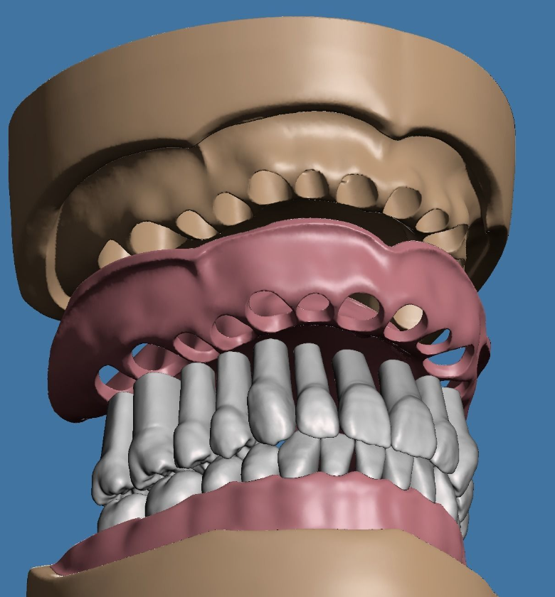 上颌和下颌牙科模型 3D 打印模型