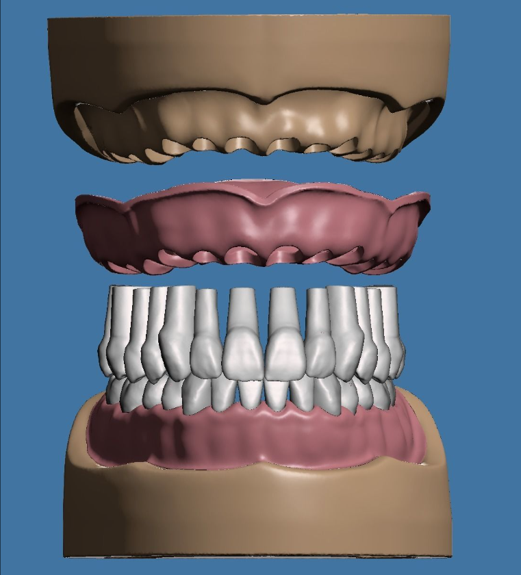 上颌和下颌牙科模型 3D 打印模型