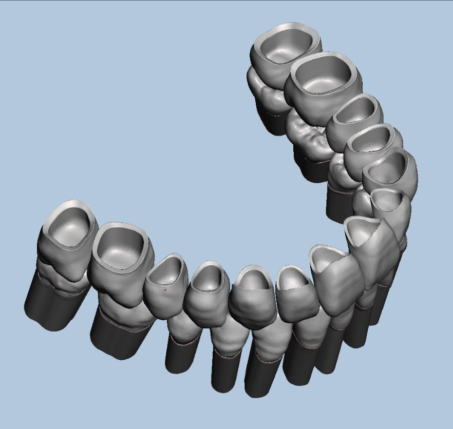 上颌和下颌牙科模型 3D 打印模型