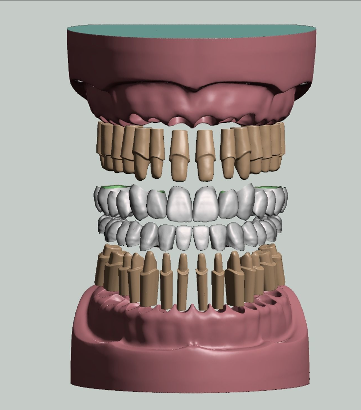 上颌和下颌牙科模型牙冠和预备模具 3D 打印模型