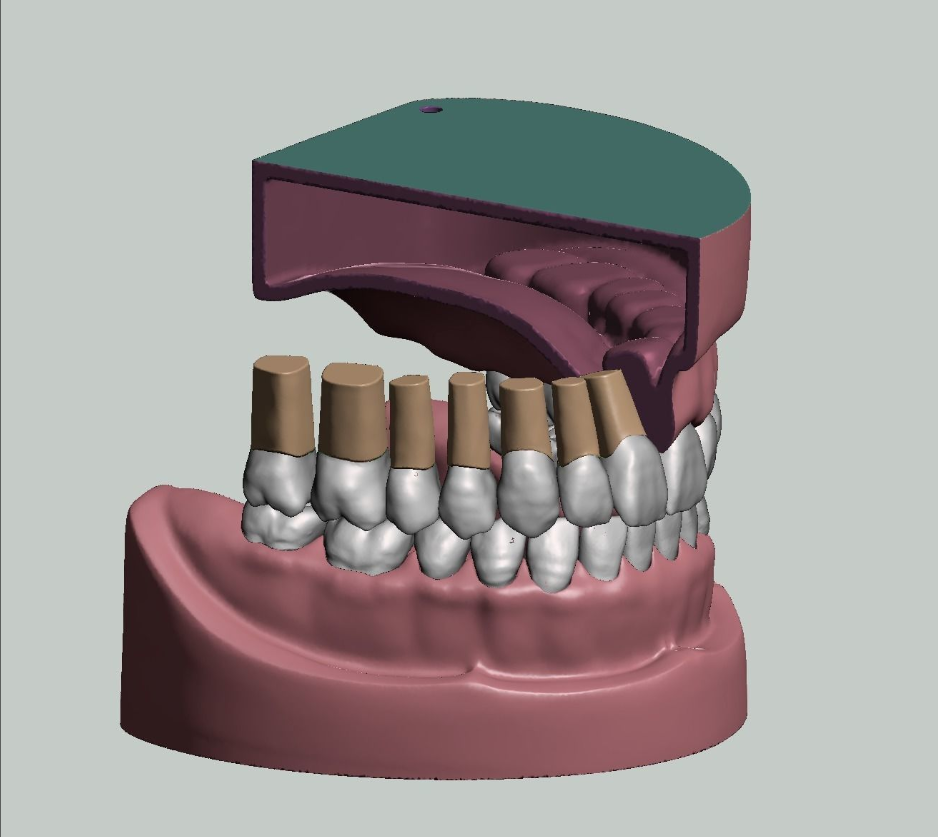 上颌和下颌牙科模型牙冠和预备模具 3D 打印模型