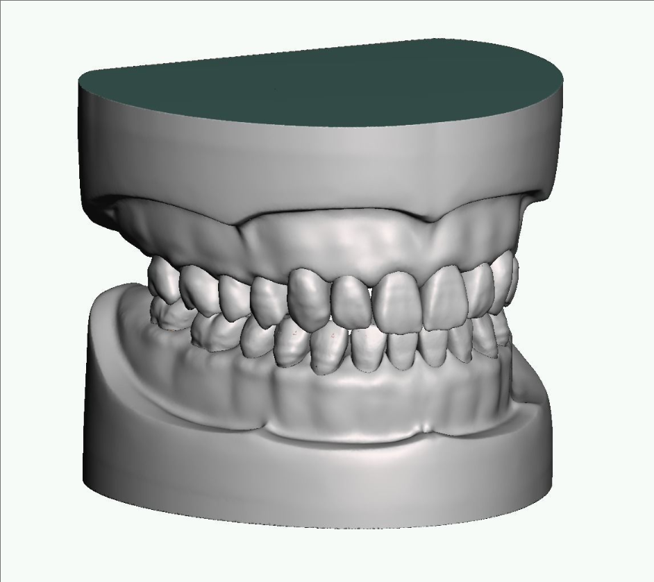 上颌和下颌牙科模型牙冠和预备模具 3D 打印模型