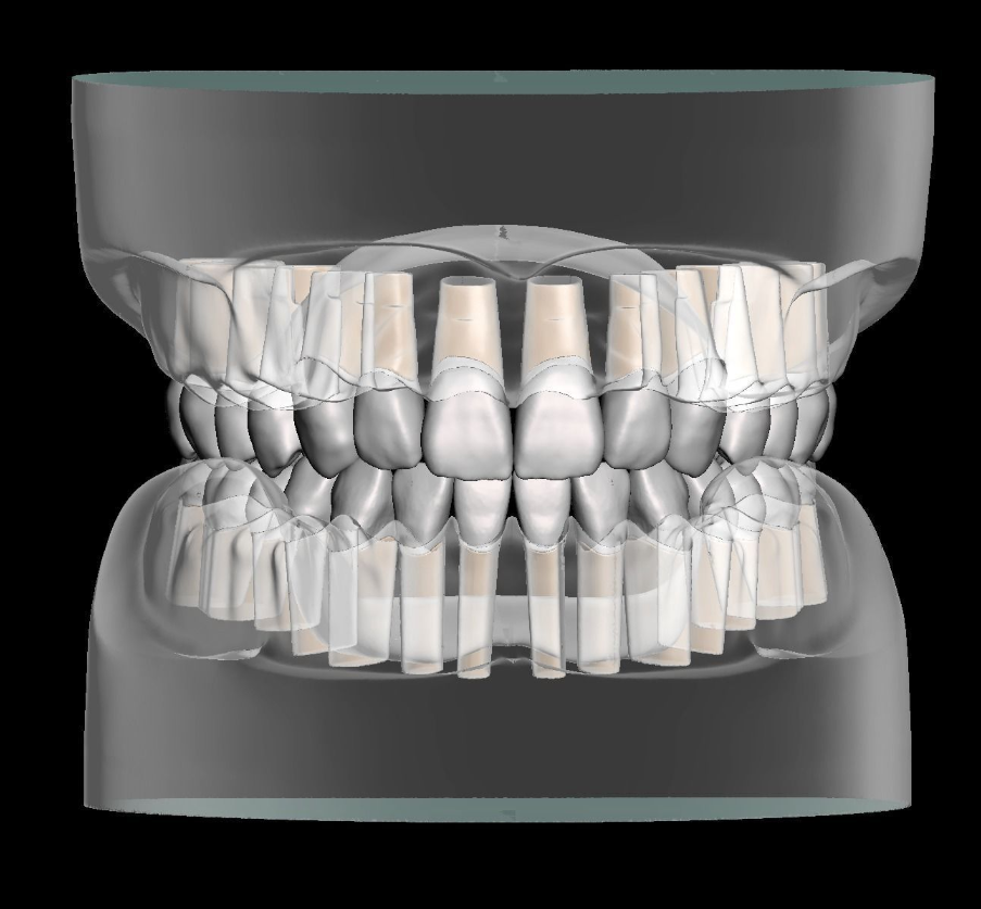 上颌和下颌牙科模型牙冠和预备模具 3D 打印模型