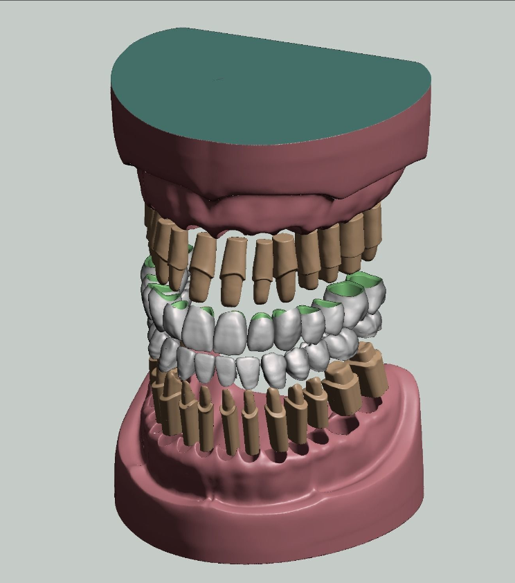 上颌和下颌牙科模型牙冠和预备模具 3D 打印模型
