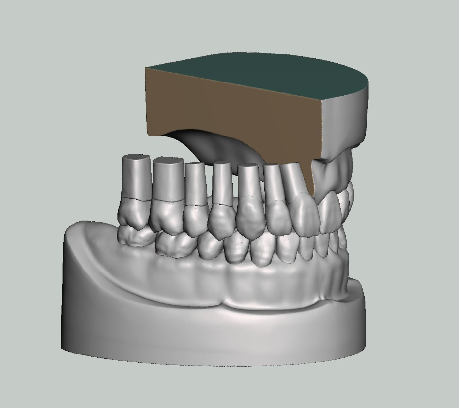 上颌和下颌牙科模型牙冠和预备模具 3D 打印模型