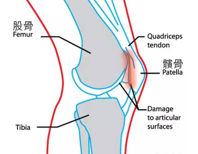 膝盖不同部位疼痛是怎么回事呢？